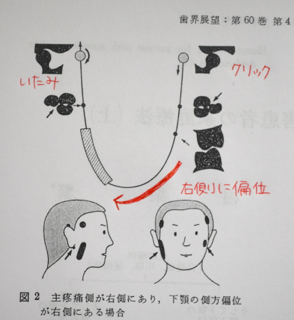 下顎の側方偏位が右側にある場合