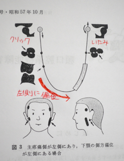 下顎の偏位が左側にある場合