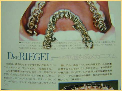 リーゲルテレスコープのご紹介〜歴史編〜 | 歯科技工所 WEBER DENTAL